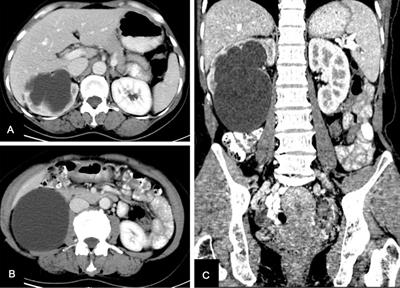 Prolonged postoperative urine leakage due to a calyceal diverticulum mimicking a renal cyst: A case report and literature review